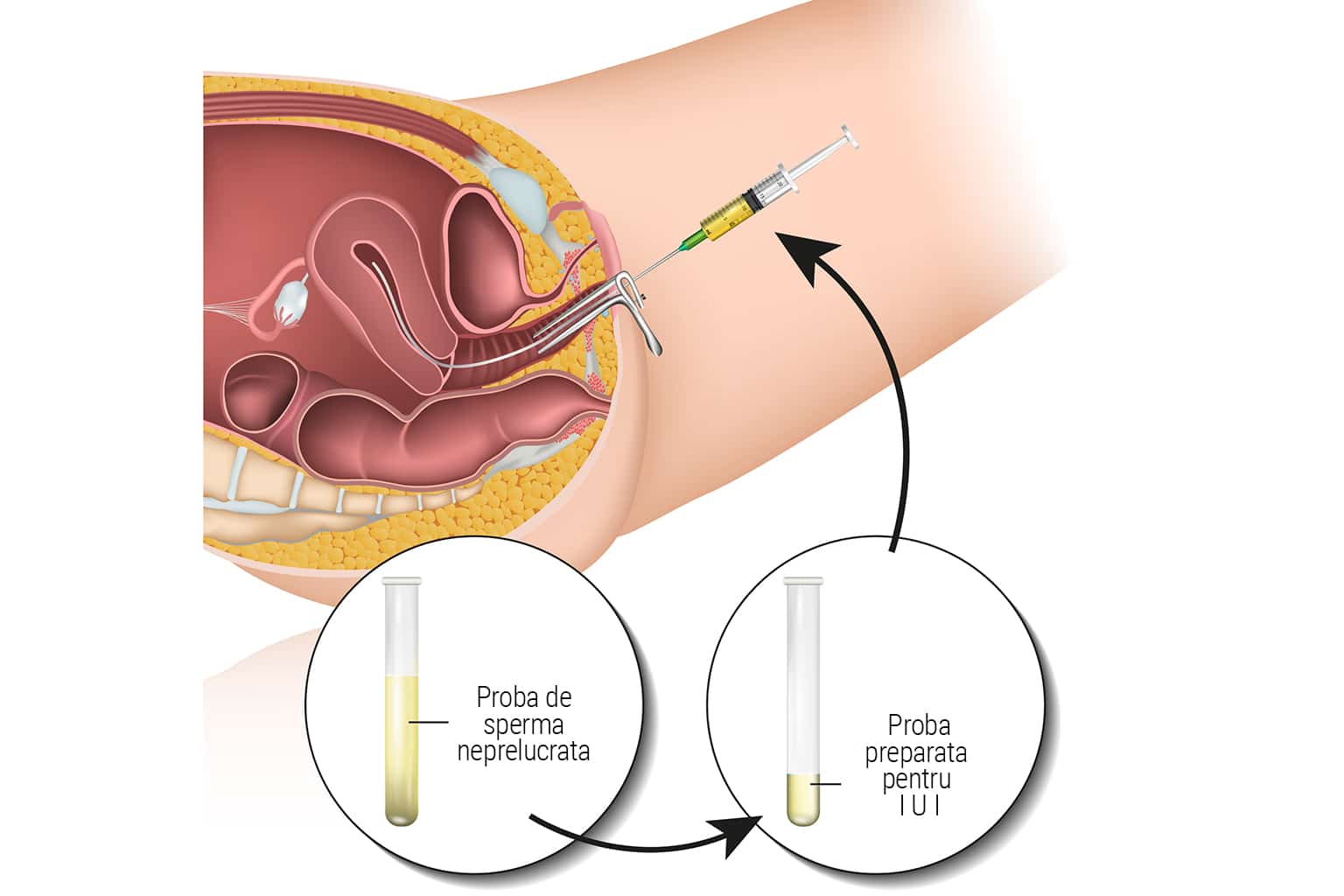 Inseminare Intrauterina (IUI)